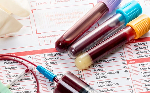 Қандағы қант деңгейін анықтау талдауы Қандағы қант деңгейін анықтау талдауы